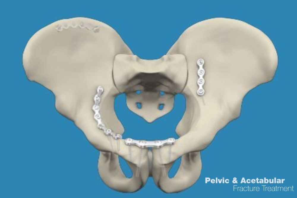 Knee Replacement Model