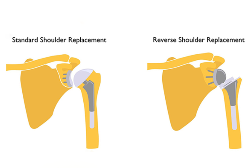 Knee Replacement Model