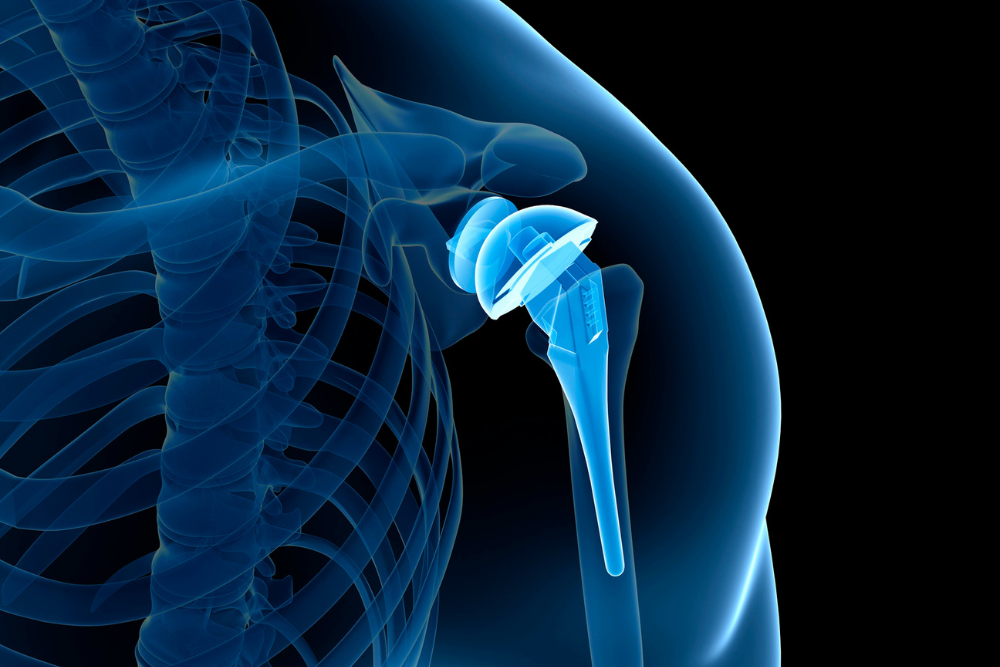 Knee Replacement Model
